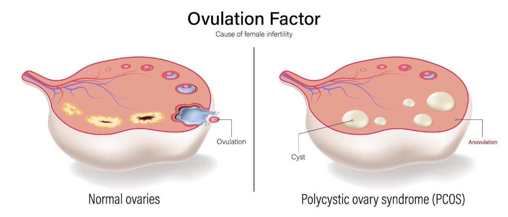 PCOS di Singapura