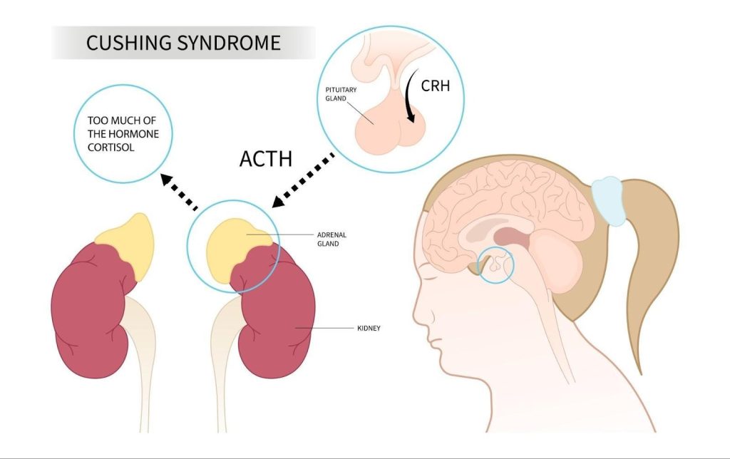 Cushing Syndrome Singapore