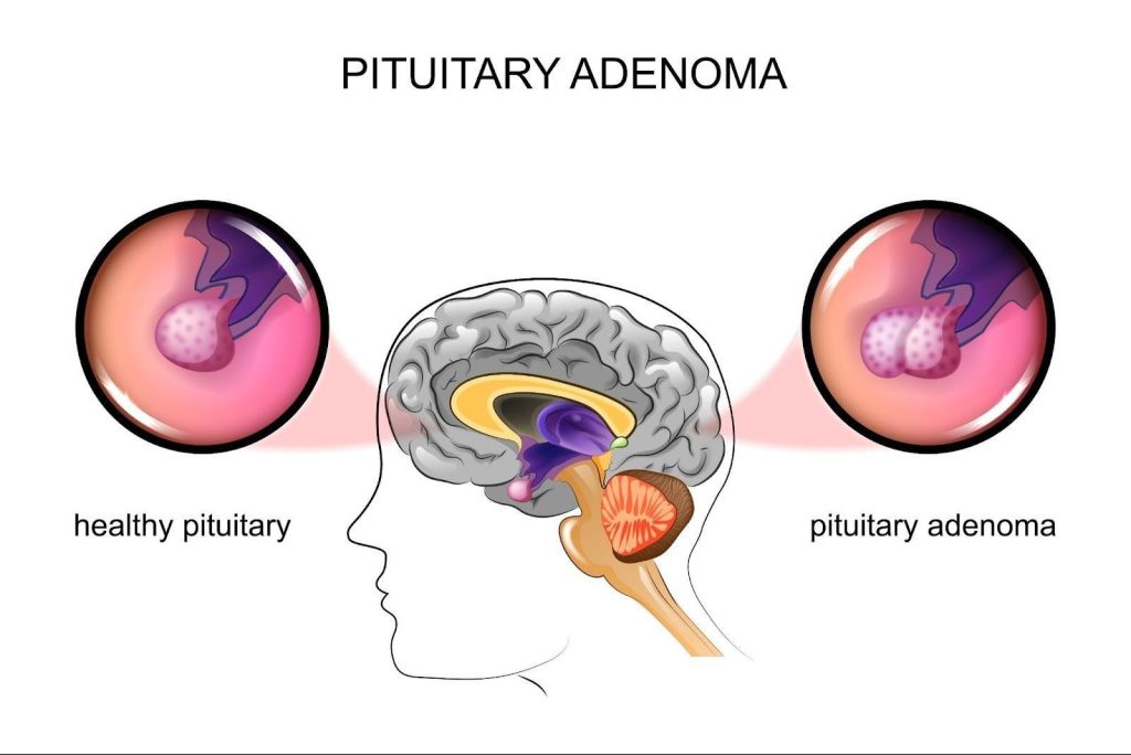 Pituitary Adenoma Singapore