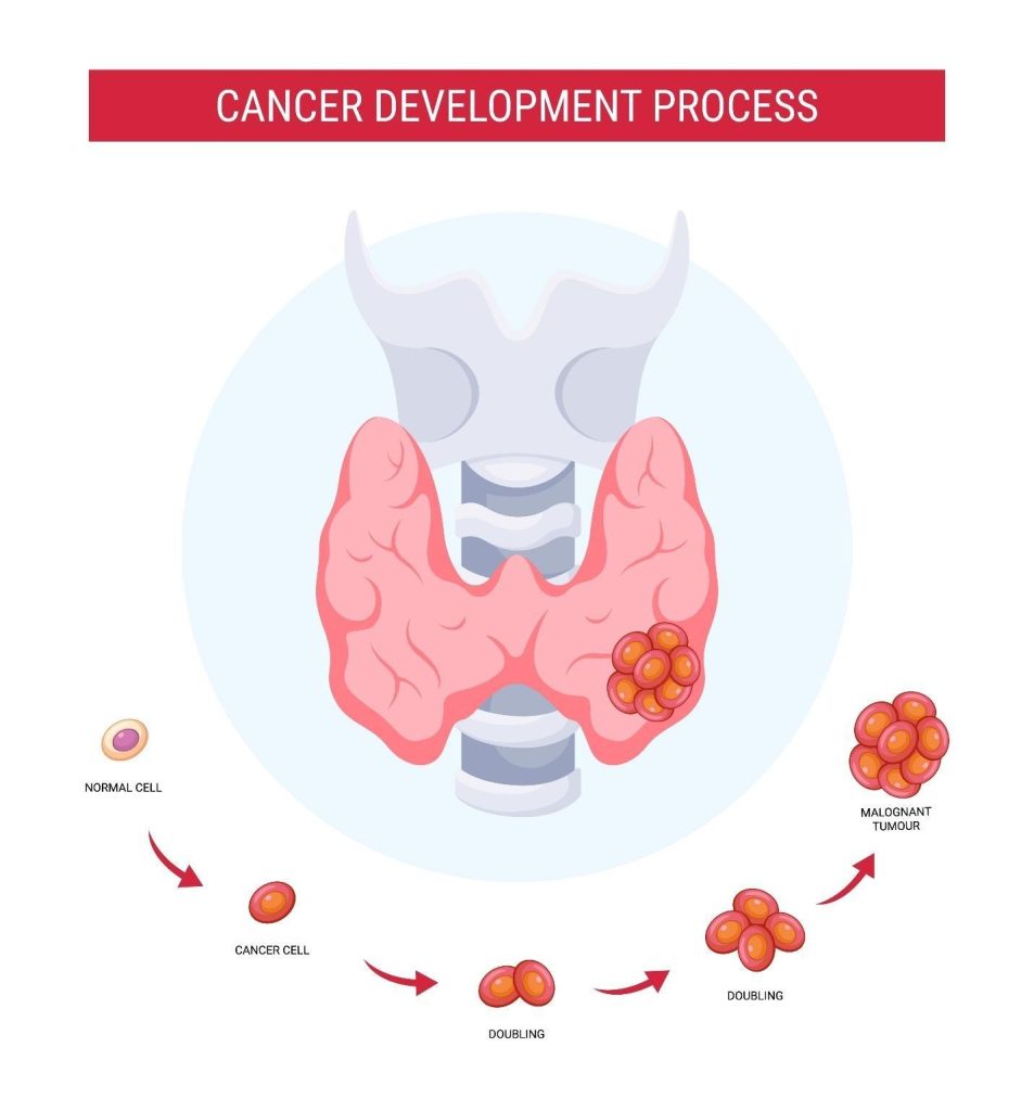 thyroid nodule cancer risk Singapore.