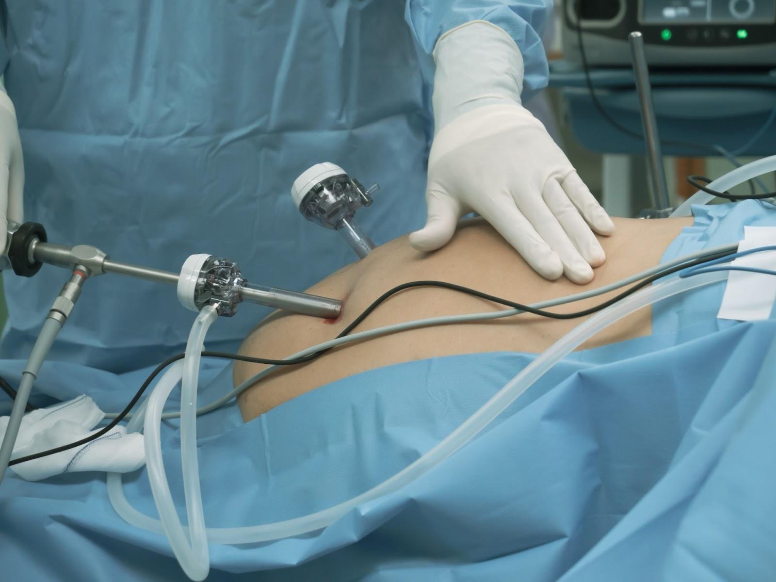 Pre-Bariatric Surgery Optimisation Singapore