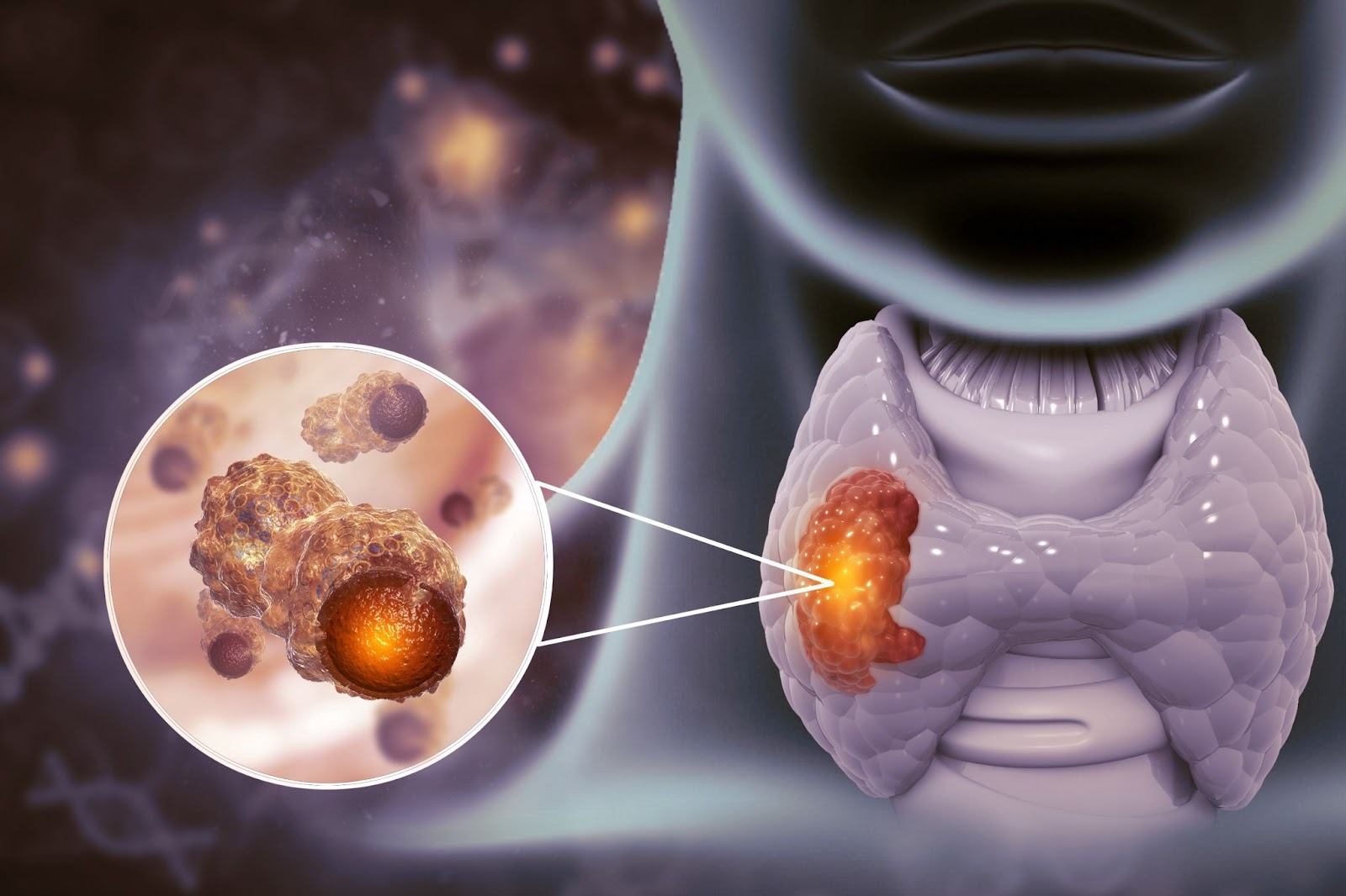 thyroid cancer Singapore.