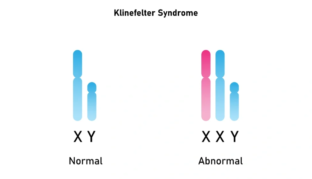 sindrom klinefelter