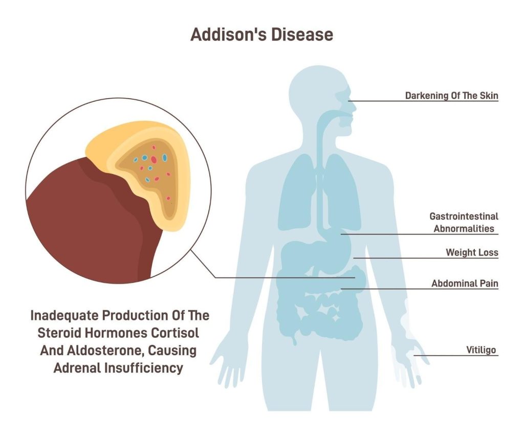 Addison’s Disease Singapore