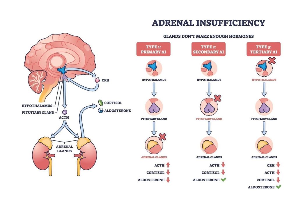 Adrenal Insufficiency Singapore